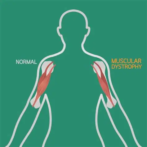 Muscular Distrophy treatment